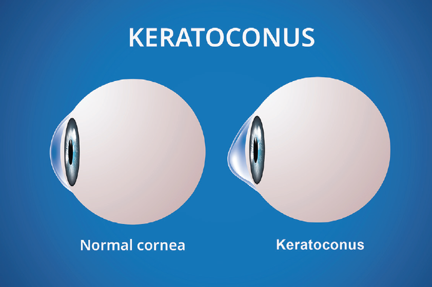 keratoconus vs normal eye