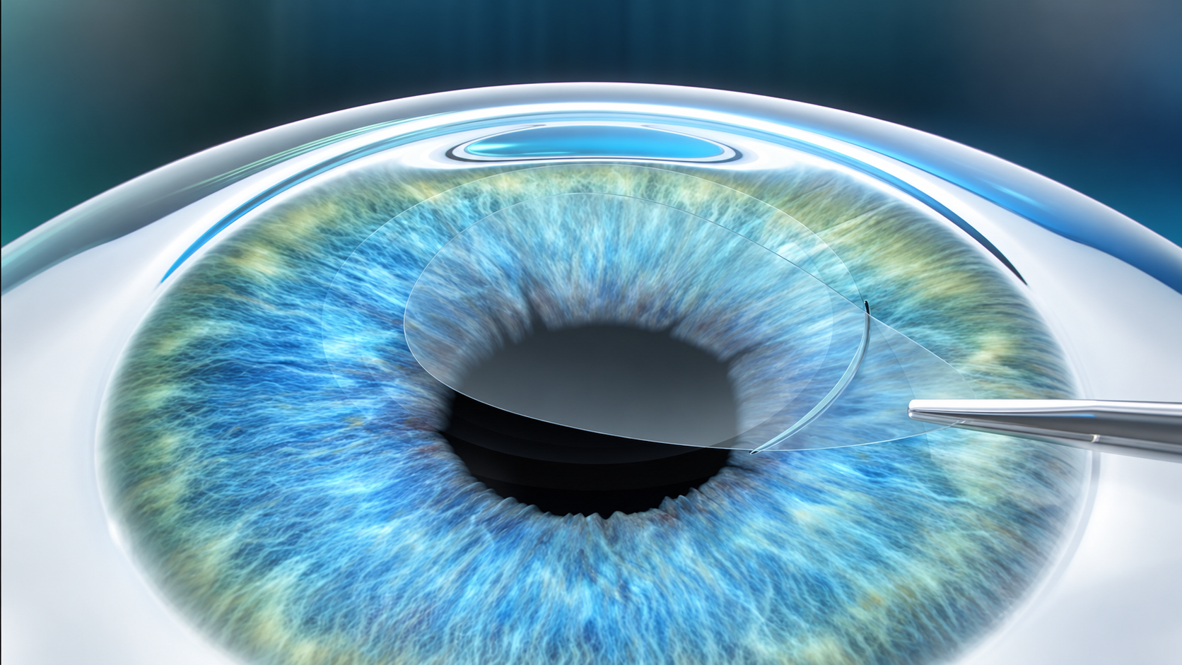 smile eye surgery in pakistan