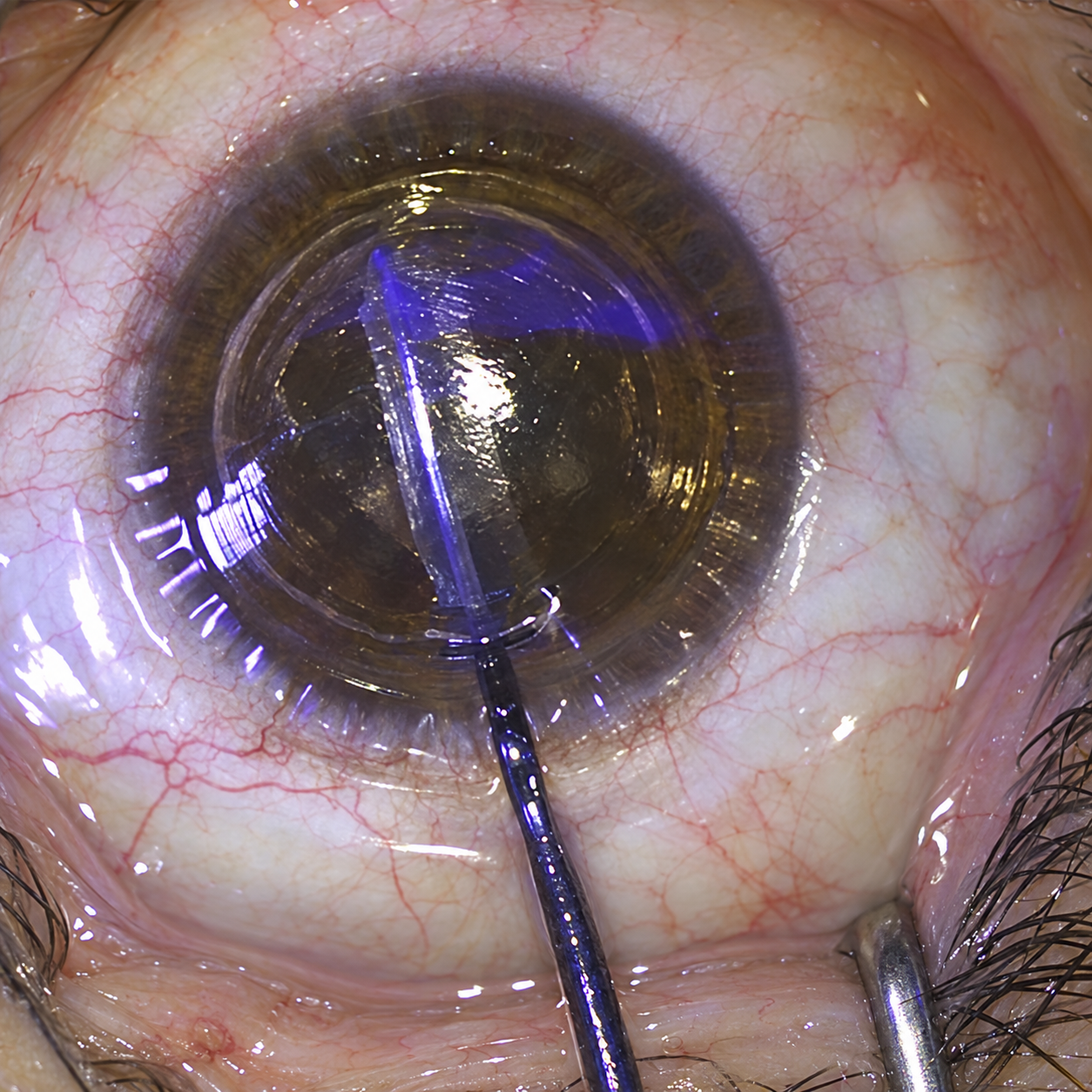 smile eye surgery in pakistan